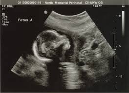 3D/4D Sonography
